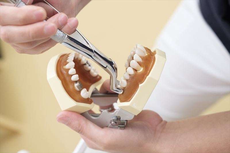 インプラントで抜歯は必要？